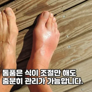 통풍에 걸렸을 때 이렇게 해 보세요.